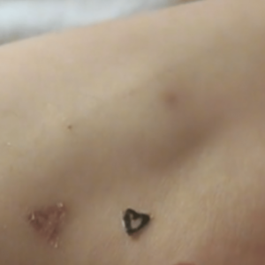 Tatuagem feita superficialmente