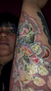 Tatuagem Infeccionada: Cliente Processa Estúdio De Reality Show Tatuagem infeccionada por caneta