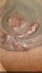 Tatuagem Infeccionada: Cliente Processa Estúdio De Reality Show tatuagem infeccionada reality show black ink 8