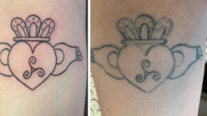 Ephemeral: Tinta de Tatuagem Que Prometia Desaparecer Decepciona Clientes ephemeral tattoo tatuagem que some sozinha tattoopediabr 1