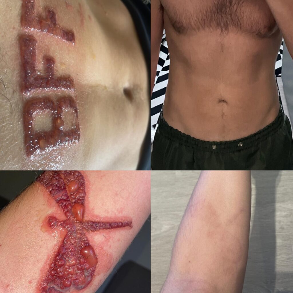 Alergia a Tatuagem de Henna Pode Causar Queimaduras de Terceiro Grau Queimadura por tatuagem de Henna