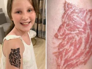 Queimadura por tatuagem de Henna