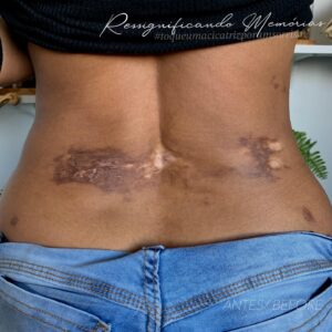 Tatuagem em cima de cicatriz