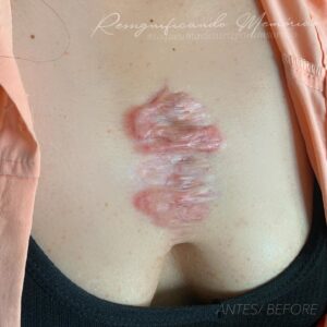 Tatuagem em cima de cicatriz