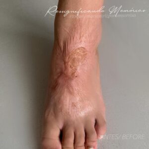 Tatuagem em cima de cicatriz