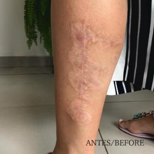 Tatuagem em cicatriz