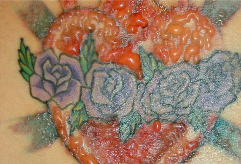 Alergia Ou Inflamação Na Tatuagem? Como Identificar E Cuidar