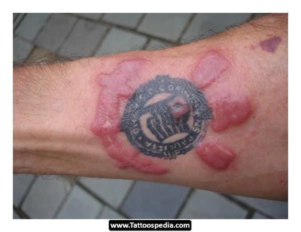 Alergia Ou Inflamação Na Tatuagem? Como Identificar E Cuidar