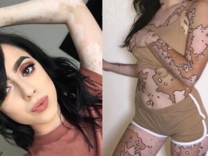Tatuagem e Vitiligo