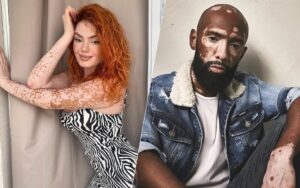 Tattoo e Vitiligo