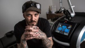 Remoção de tatuagem com laser