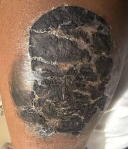 Tatuagem infeccionada